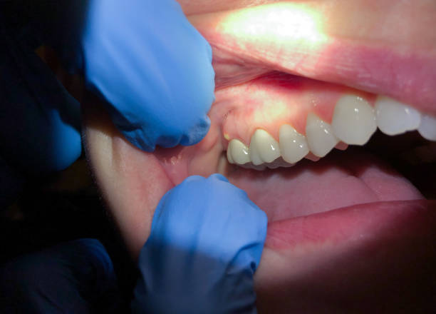 Best Emergency Treatment for Dental Infections or Abscesses in Oklahoma, PA